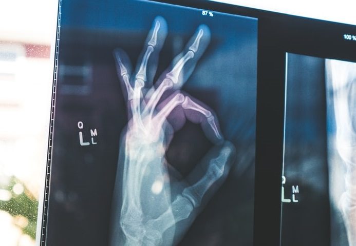 ilustračné foto - rontgenová snímka ruky